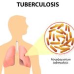 Tuberculosis